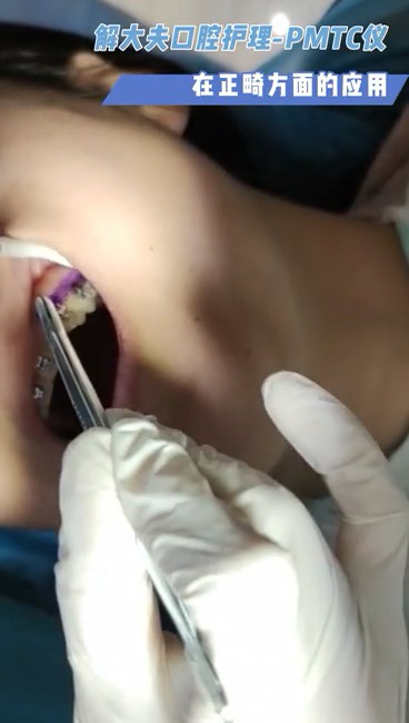 口腔护理-PMTC仪在正畸方面的应用
